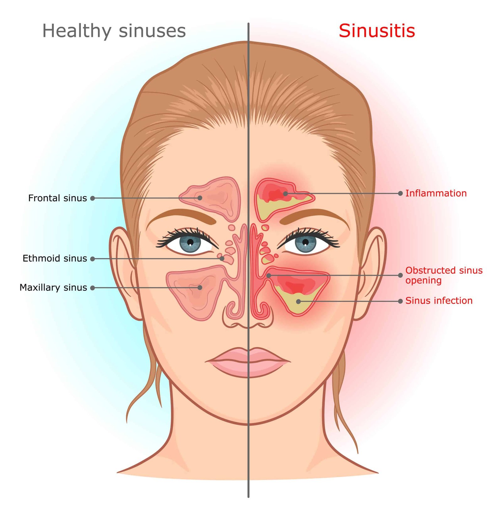 Sinus-Infection-Warning-Signs-and-Symptoms